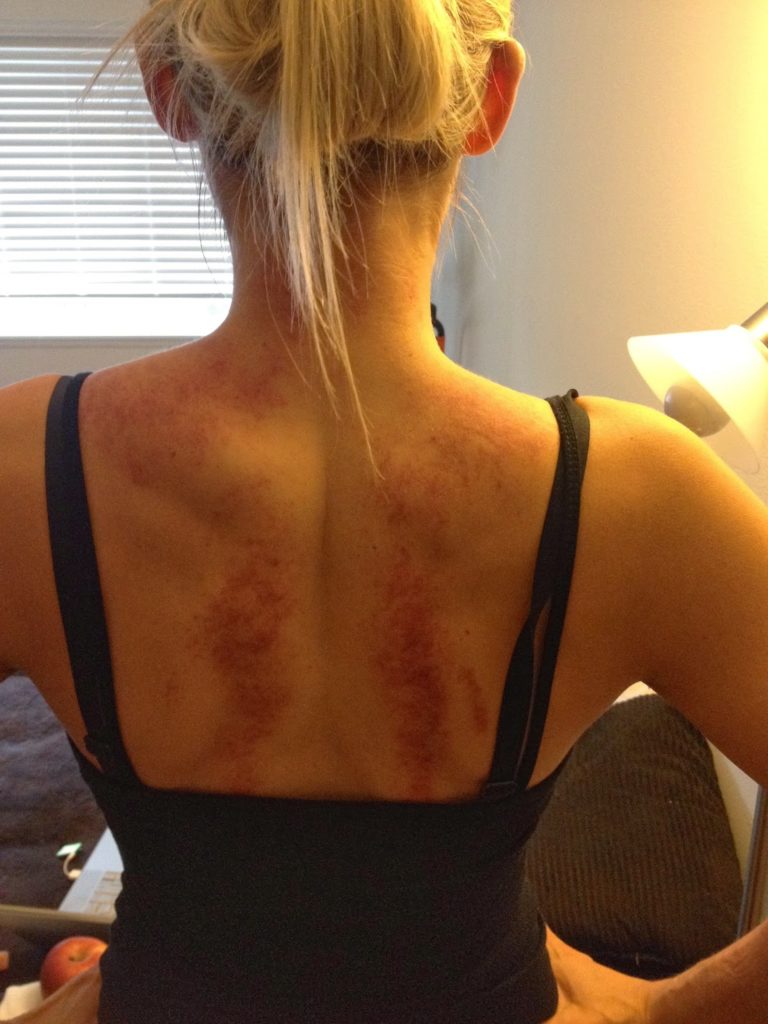  Some self care in the form of Gua Sha, cupping, and acupuncture…